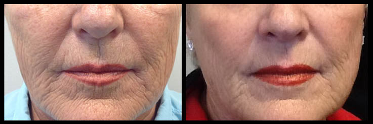 Laser Resurfacing before and after Love Skin and Hair Sevenoaks Kent